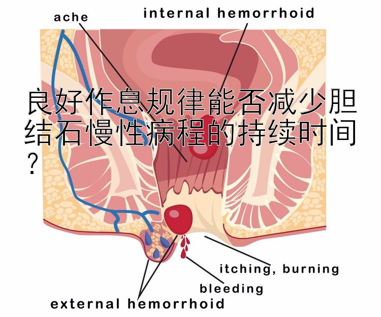 良好作息规律能否减少胆结石慢性病程的持续时间？